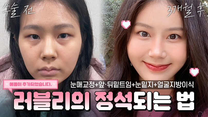 눈성형으로 졸린 이미지에서 러블리한 외모로 변신!! #눈매교정 #눈성형 #앞트임