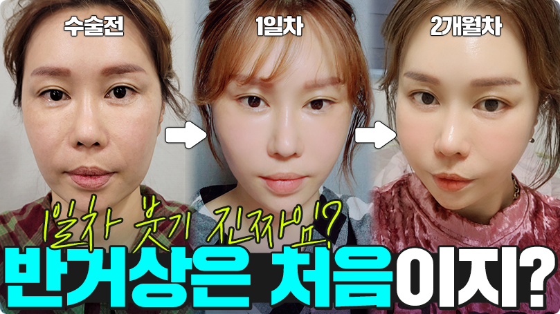 수술 후 붓기 없는거 실화?!! 반거상은 처음이지? #리프팅 #안티에이징 #거상수술 #반거상