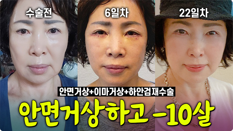 안면거상 하고 10살 어려졌다! #안면거상 #하안검 #리프팅