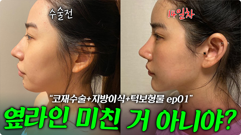 코 재수술+턱 보형물로 세련미 장착!! [1부] #코성형 #코재수술 #매부리코