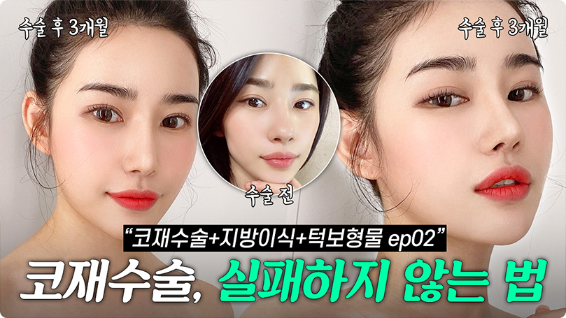 😜코 재수술+턱 보형물로 세련미 장착!!😜 [2부] #코성형 #코재수술 #매부리코