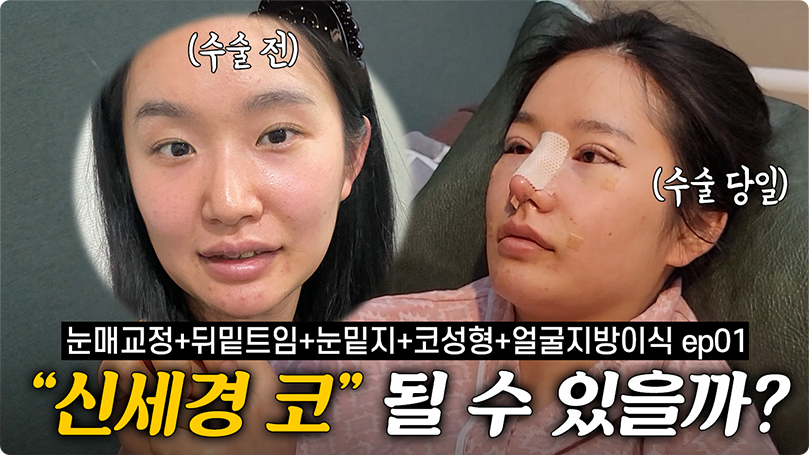 눈매교정으로 또렷한 인상! 이뻐졌다는 말 많이 들어요ㅎㅎ [1부] #눈매교정 #코성형 #눈밑지방재배치