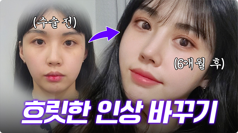 ❤️흐릿하던 얼굴, 또렷한 얼굴로 변신하기❤️ #코수술 #눈재수술 #지방흡입