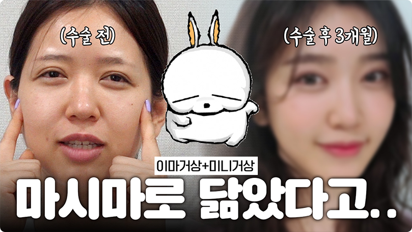 처진 볼살&눈매, 쑥 들어간 무턱😥 놀랍도록 이뻐진 변화!? #미니거상 #턱보형물 #얼굴지방흡입 #이마거상