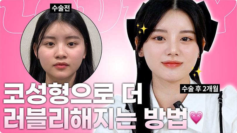 코성형만 했는데 더 ❤️러블리해진❤️ 이유