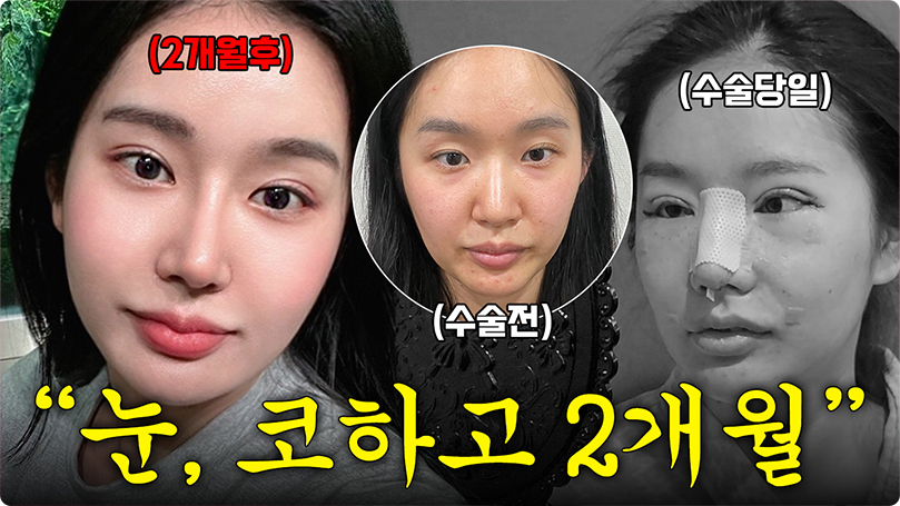 눈, 코 성형하고 2개월됨😏 [2부]