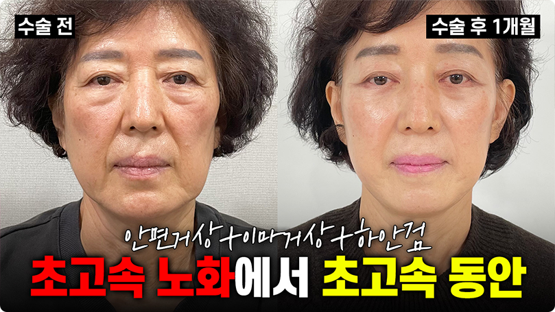 초고속 노화에서 초고속 동안 되는 방법! #안면거상술 #이마거상술 #하안검