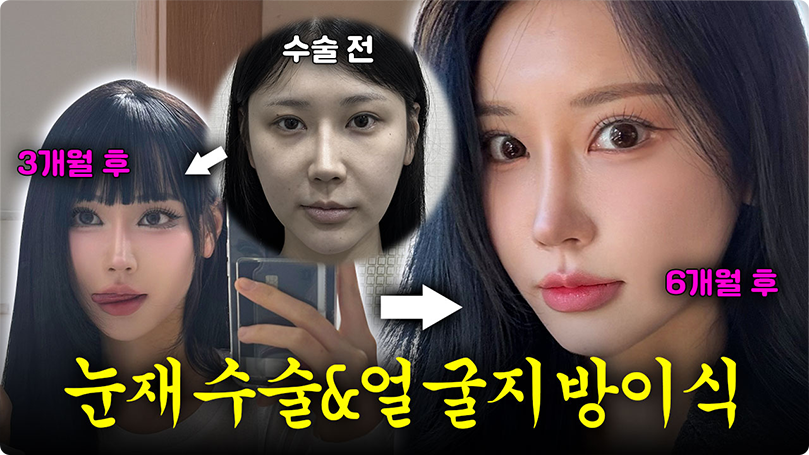 더 이상의 재수술은 없습니다! 🙅‍♀️ 마지막 재수술 브이로그 #눈재수술잘하는곳